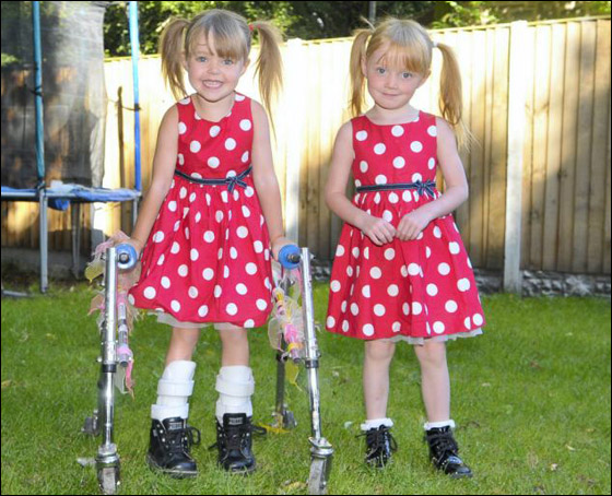 طفلة تعاني من شلل دماغي تحلم بان تتمكن من الرقص مثل توأمها!!