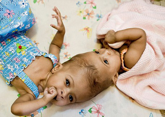 نجاة توأمتين ملتصقتين بقمة الرأس بعد عملية جراحية معقدة! 