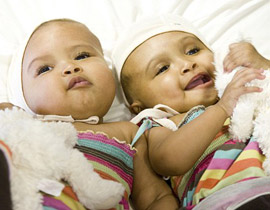 نجاة توأمتين ملتصقتين بقمة الرأس بعد عملية جراحية معقدة! 