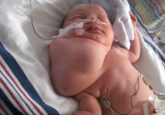 ازالة ورم ضخم من رقبة طفلة يفوق حجم رأسها بنجاح!