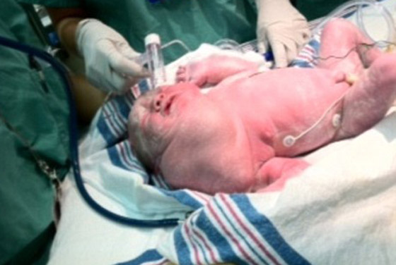 ازالة ورم ضخم من رقبة طفلة يفوق حجم رأسها بنجاح!