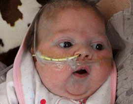 نجاة أصغر طفلة بعد ان خضعت لعملية معقدة لزرع الكبد!