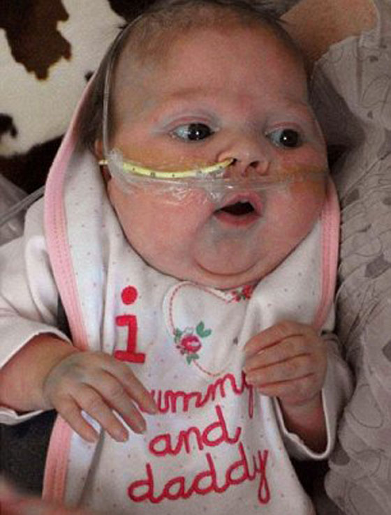 نجاة أصغر طفلة بعد ان خضعت لعملية معقدة لزرع الكبد!