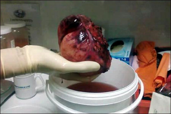 معجزة طبية: استئصال ورم سرطاني ضخم من صدر طفلة!!