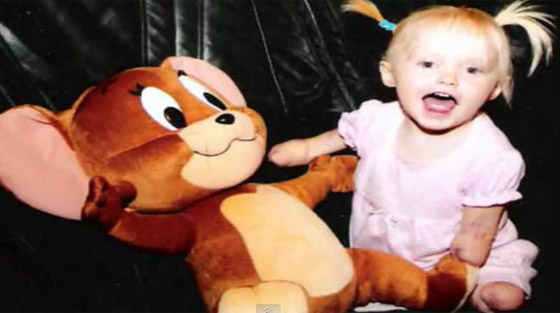 طفلة مبتورة الارجل والايدي تنضم لفريق كرة القدم بمدرستها!! 