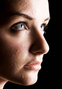 اليك طرق لمعالجة الحبوب واخفائها!! 