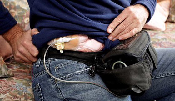 انقاذ بريطاني بزراعة قلب صناعي يشحن على ولاعة السجائر!