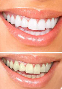 تابعي هذه الوصفات لتحافظي على بياض اسنانك!