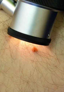 ابتكار لاصقة مشعة تشفي سرطان الجلد خلال ساعتين فقط!!