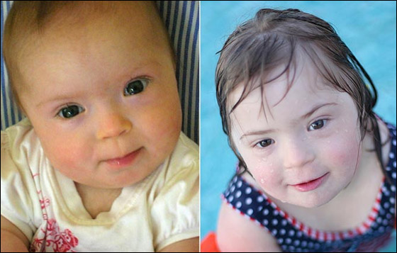 طفلة تتحدى الأطباء وتصبح عارضة أزياء بالرغم من مرضها!!