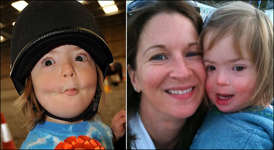 طفلة تتحدى الأطباء وتصبح عارضة أزياء بالرغم من مرضها!!