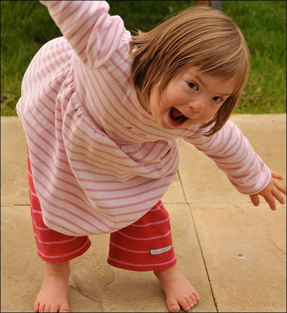 طفلة تتحدى الأطباء وتصبح عارضة أزياء بالرغم من مرضها!!