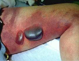 بكتيريا فتاكة جديدة "يو اس ايه-300" آكلة للحوم البشر تنتشر في بريطانيا!