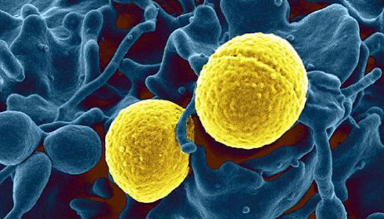 بكتيريا فتاكة جديدة "يو اس ايه-300" آكلة للحوم البشر تنتشر في بريطانيا!