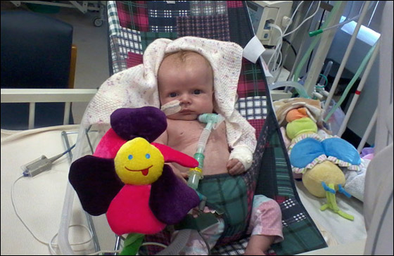 الطفلة ياسمين اصغر شخص يجري جراحة القلب المفتوح في العالم!