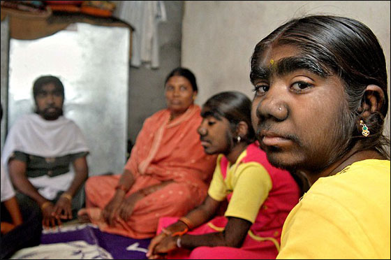 مؤثر.. قصة ثلاث شقيقات هنديات يعانين من متلازمة الذئب! 