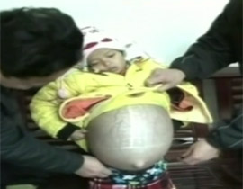 مرض غامض ينفخ بطن طفلة بدون توقف حتى اصبحت تبدو حاملا!