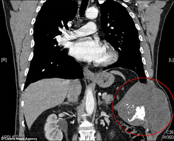 بعد استئصال الورم: اعادة ترميم صدر بريطاني باستخدام الخرسانة!