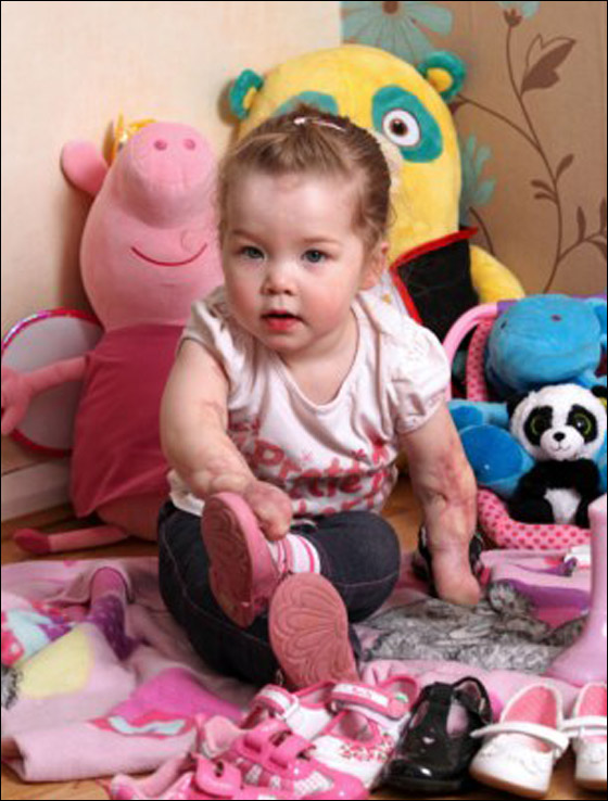 طفلة تخطو خطواتها للمرة الاولى بعد اسئصال جميع اطرافها