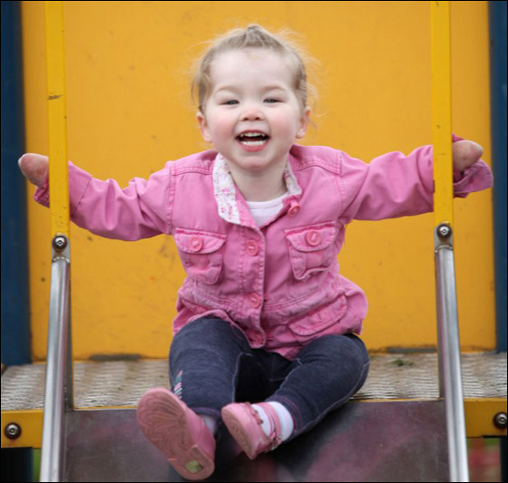 طفلة تخطو خطواتها للمرة الاولى بعد اسئصال جميع اطرافها