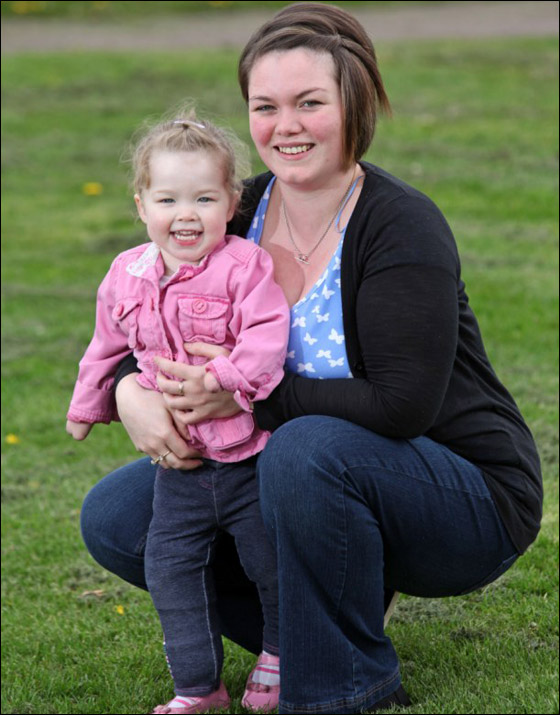 طفلة تخطو خطواتها للمرة الاولى بعد اسئصال جميع اطرافها