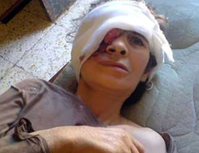 حالة مرضية غريبة: جزائرية مصابة بورم ينهش وجهها!