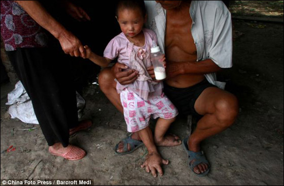 طفلة 3 سنوات ممنوعة من ارتداء الاحذية بسبب كبر قدميها!