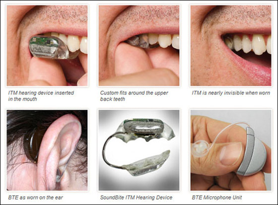 منظومة جديدة تعيد السمع للأطرش عن طريق الاسنان!!