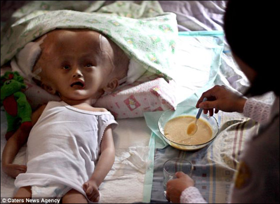 طفلة تحتاج لمعجزة طبية لتتخلص من مرض جعلها كمخلوقات الفضاء