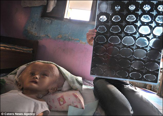 طفلة تحتاج لمعجزة طبية لتتخلص من مرض جعلها كمخلوقات الفضاء