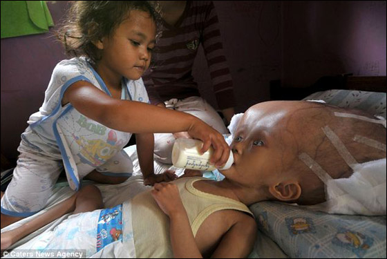 طفلة تحتاج لمعجزة طبية لتتخلص من مرض جعلها كمخلوقات الفضاء