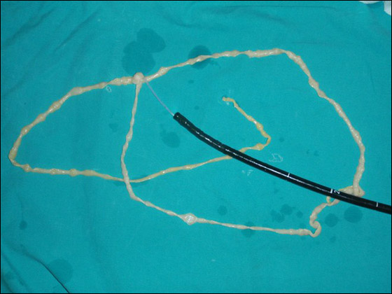 بالصور.. اطباء يستخرجون دودة طولها 2.5 متر من امعاء مريض!!