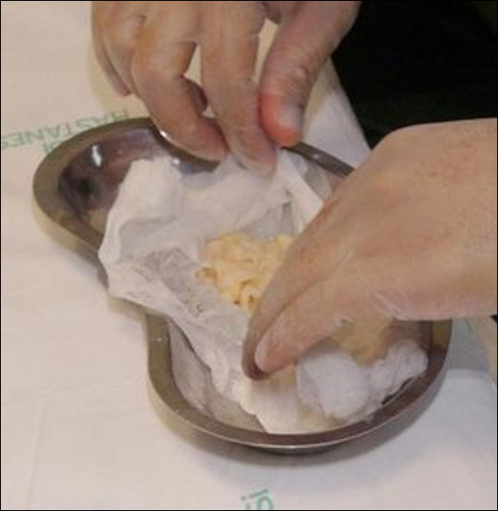 بالصور.. اطباء يستخرجون دودة طولها 2.5 متر من امعاء مريض!!