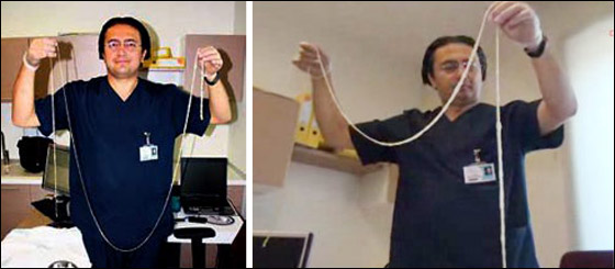 بالصور.. اطباء يستخرجون دودة طولها 2.5 متر من امعاء مريض!!