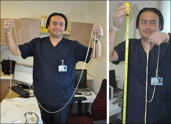 بالصور.. اطباء يستخرجون دودة طولها 2.5 متر من امعاء مريض!!