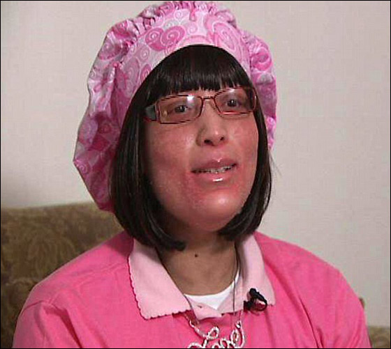 حالة غريبة لشابة ينمو على جسمها أظافر بدلا من الشعر!