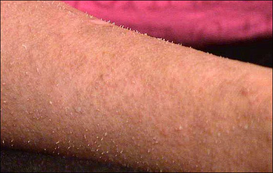 حالة غريبة لشابة ينمو على جسمها أظافر بدلا من الشعر!