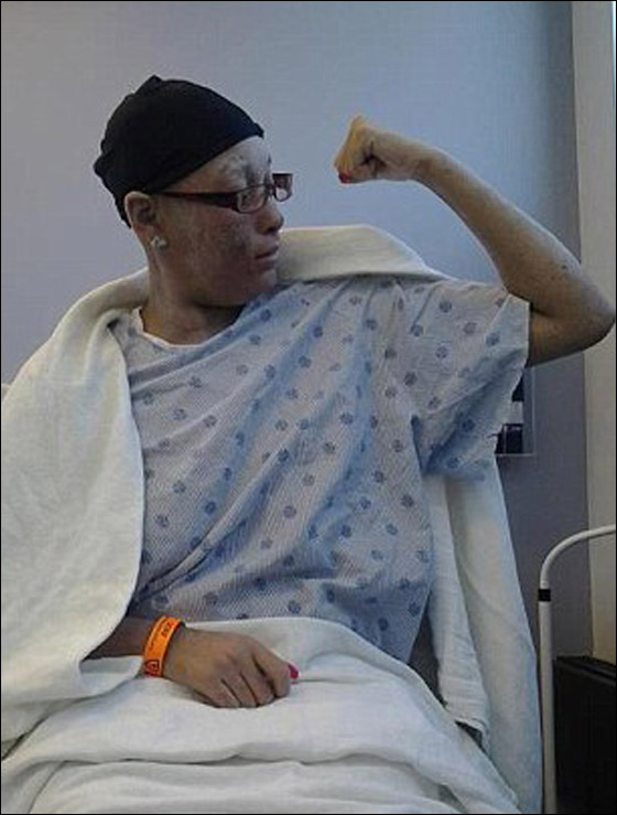 حالة غريبة لشابة ينمو على جسمها أظافر بدلا من الشعر!