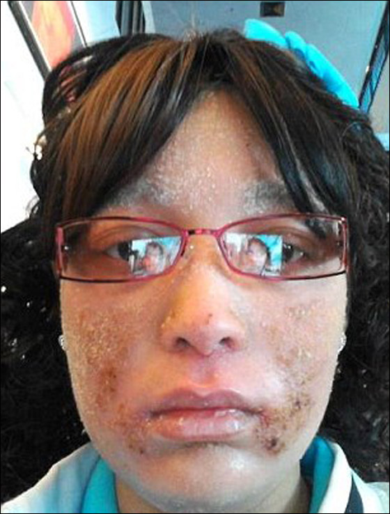 حالة غريبة لشابة ينمو على جسمها أظافر بدلا من الشعر!