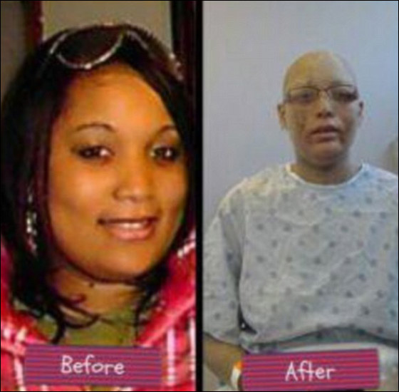 حالة غريبة لشابة ينمو على جسمها أظافر بدلا من الشعر!