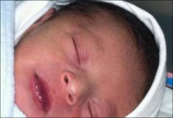 ولادة نادرة لطفل سعودي قلبه في اليمين وكبده في اليسار