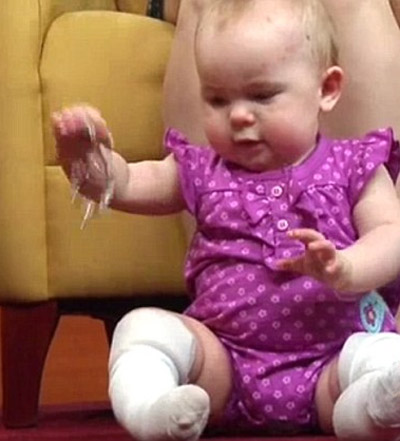 حالة نادرة تترك طفلة من دون جلد على أرجلها مدى حياتها!