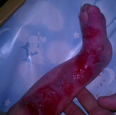 حالة نادرة تترك طفلة من دون جلد على أرجلها مدى حياتها!