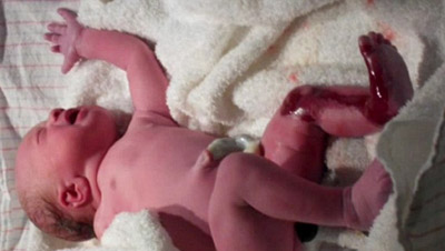 حالة نادرة تترك طفلة من دون جلد على أرجلها مدى حياتها!